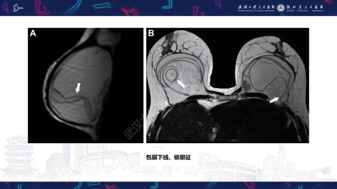 【PPT】隆胸术后并发症MRI诊断-28