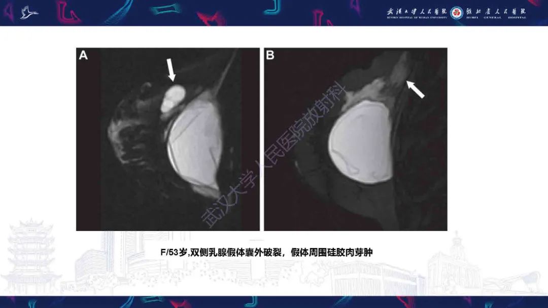 【PPT】隆胸术后并发症MRI诊断-29