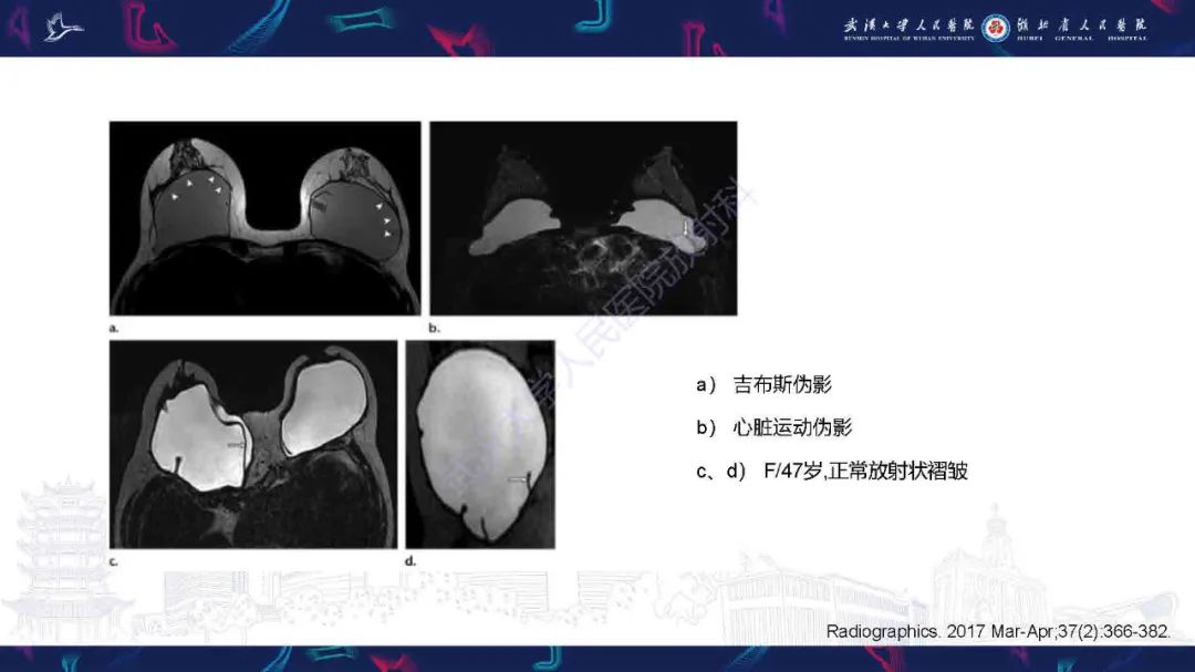 【PPT】隆胸术后并发症MRI诊断-33