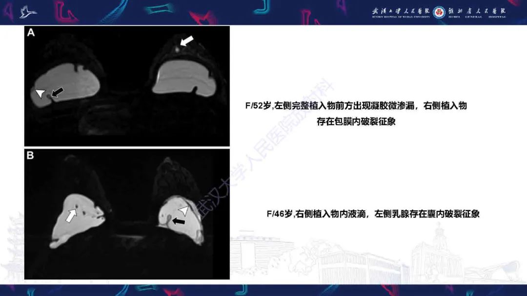 【PPT】隆胸术后并发症MRI诊断-34