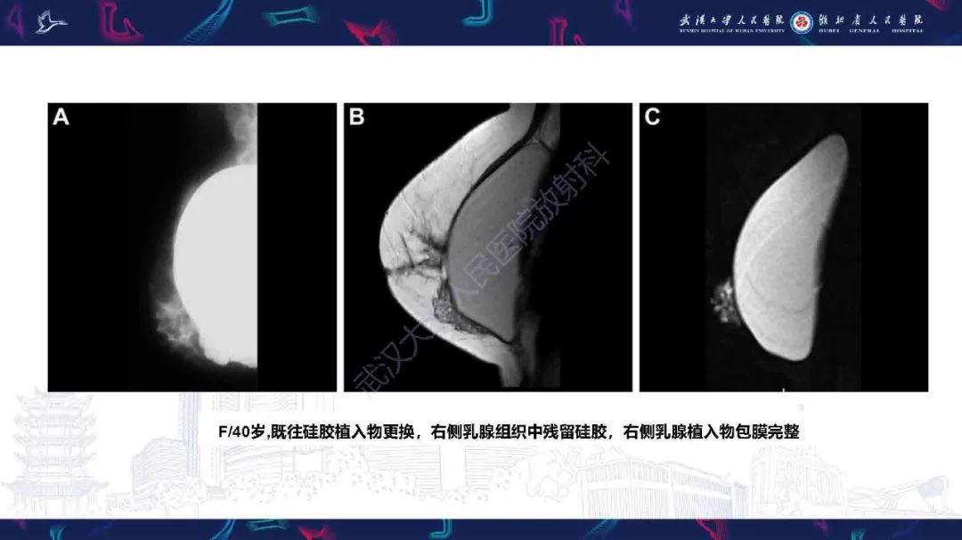 【PPT】隆胸术后并发症MRI诊断-35