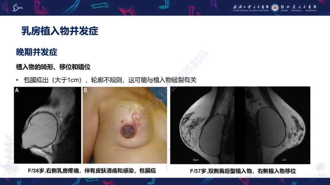 【PPT】隆胸术后并发症MRI诊断-36