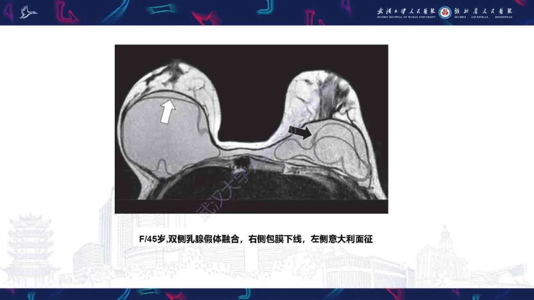 【PPT】隆胸术后并发症MRI诊断-37