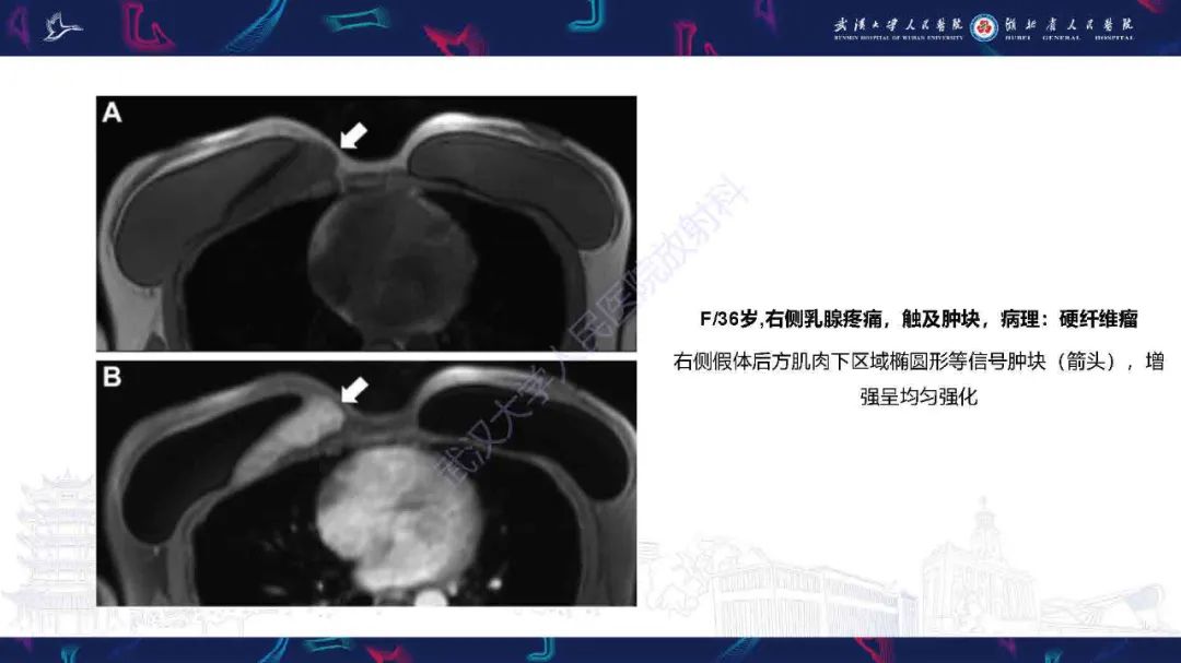 【PPT】隆胸术后并发症MRI诊断-39