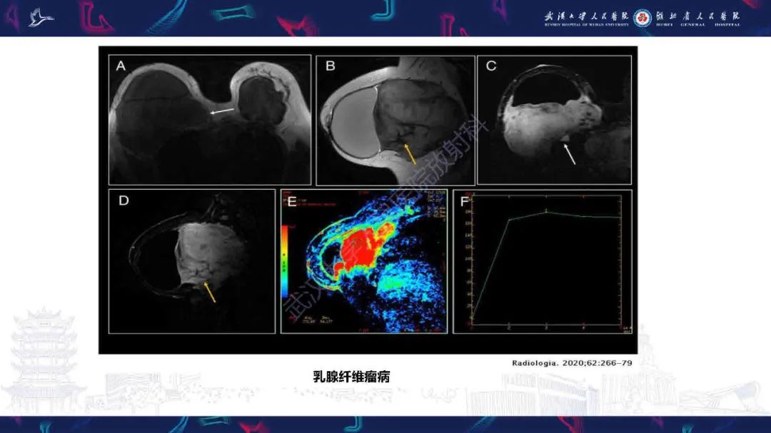 【PPT】隆胸术后并发症MRI诊断-40