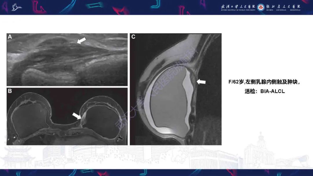 【PPT】隆胸术后并发症MRI诊断-42