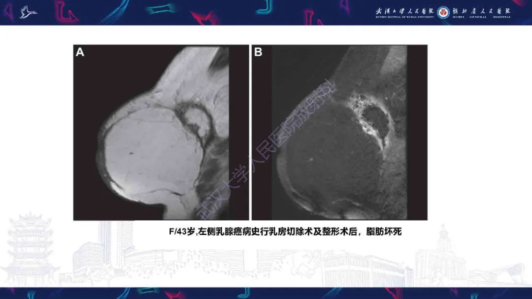 【PPT】隆胸术后并发症MRI诊断-44