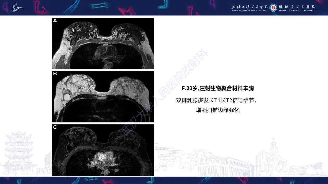 【PPT】隆胸术后并发症MRI诊断-46