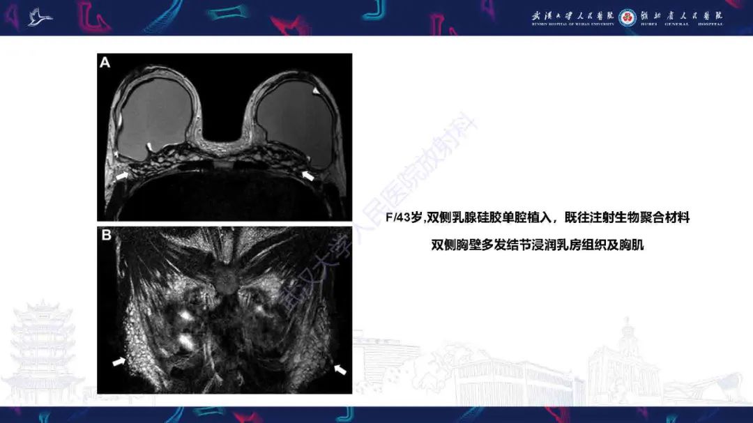 【PPT】隆胸术后并发症MRI诊断-47