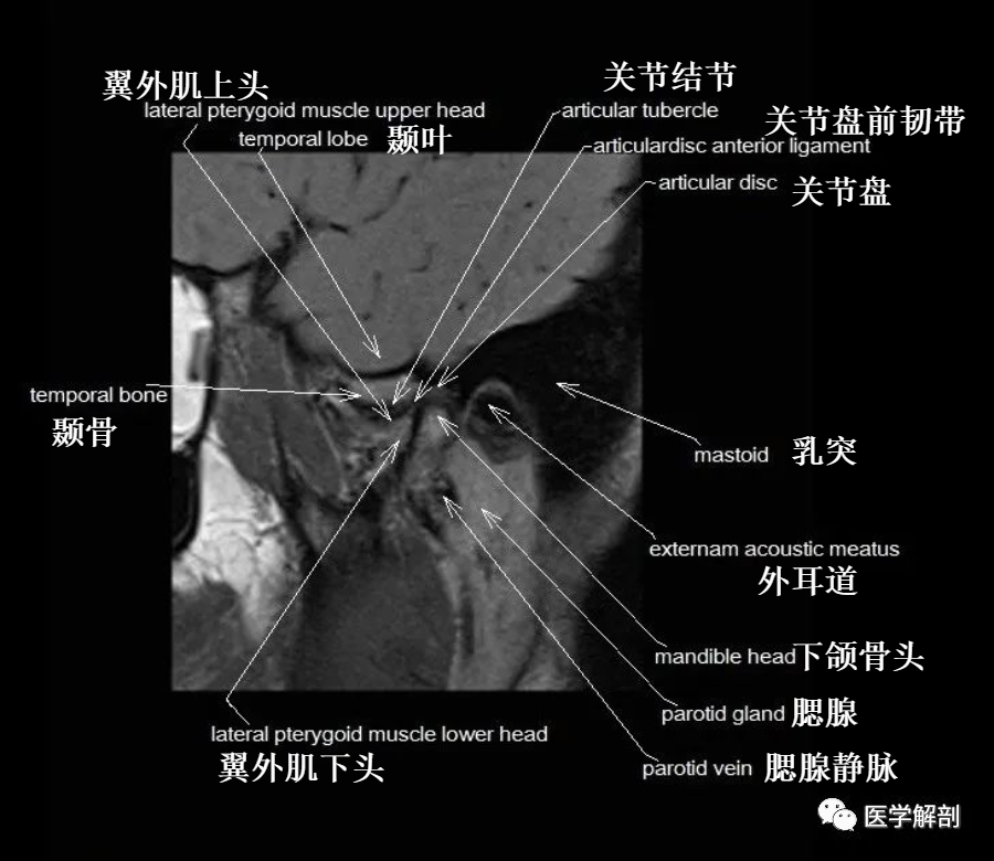 颞下颌关节MR解剖图谱-6