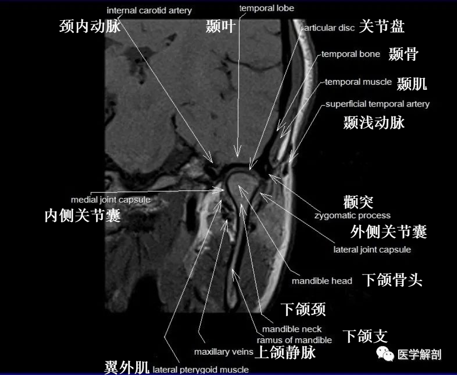 颞下颌关节MR解剖图谱-11