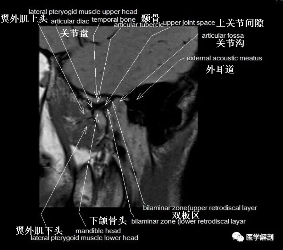 颞下颌关节MR解剖图谱-12