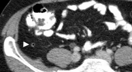 阑尾炎的影像鉴别诊断-1