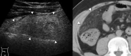 阑尾炎的影像鉴别诊断-5