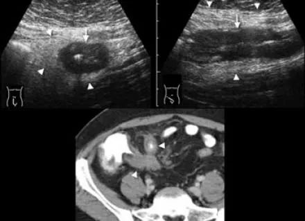 阑尾炎的影像鉴别诊断-8