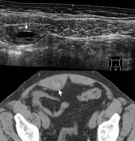 阑尾炎的影像鉴别诊断-9