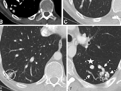 肺动静脉畸形及类似病变的CT表现
