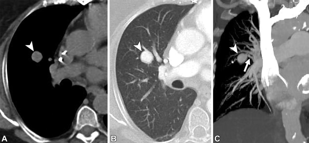 肺动静脉畸形及类似病变的CT表现-4