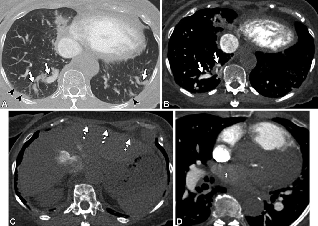 肺动静脉畸形及类似病变的CT表现-5