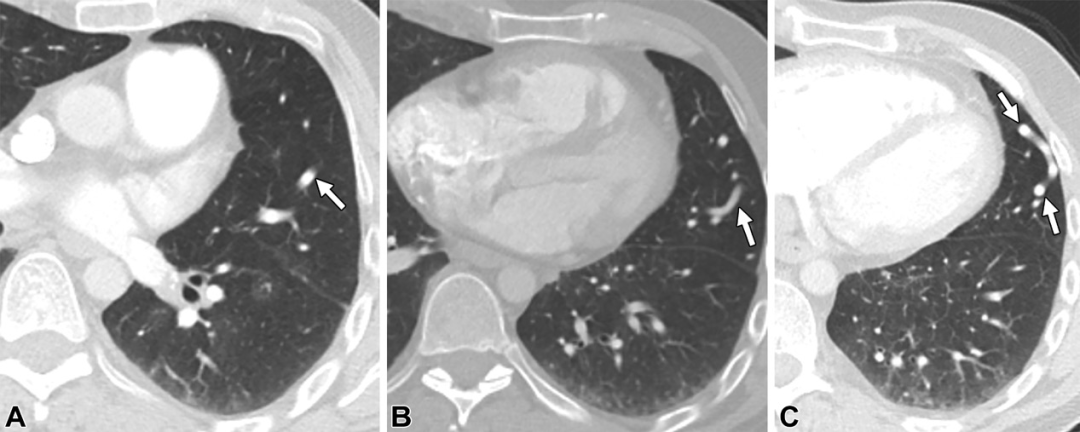 肺动静脉畸形及类似病变的CT表现-3
