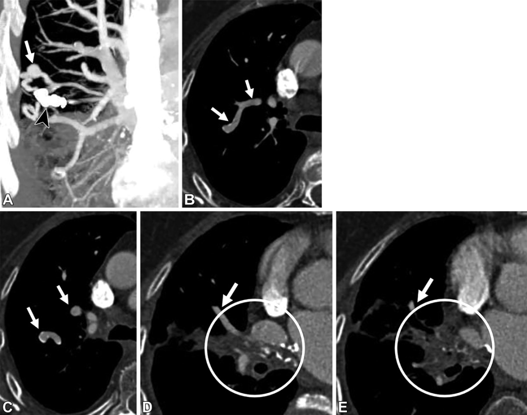 肺动静脉畸形及类似病变的CT表现-2
