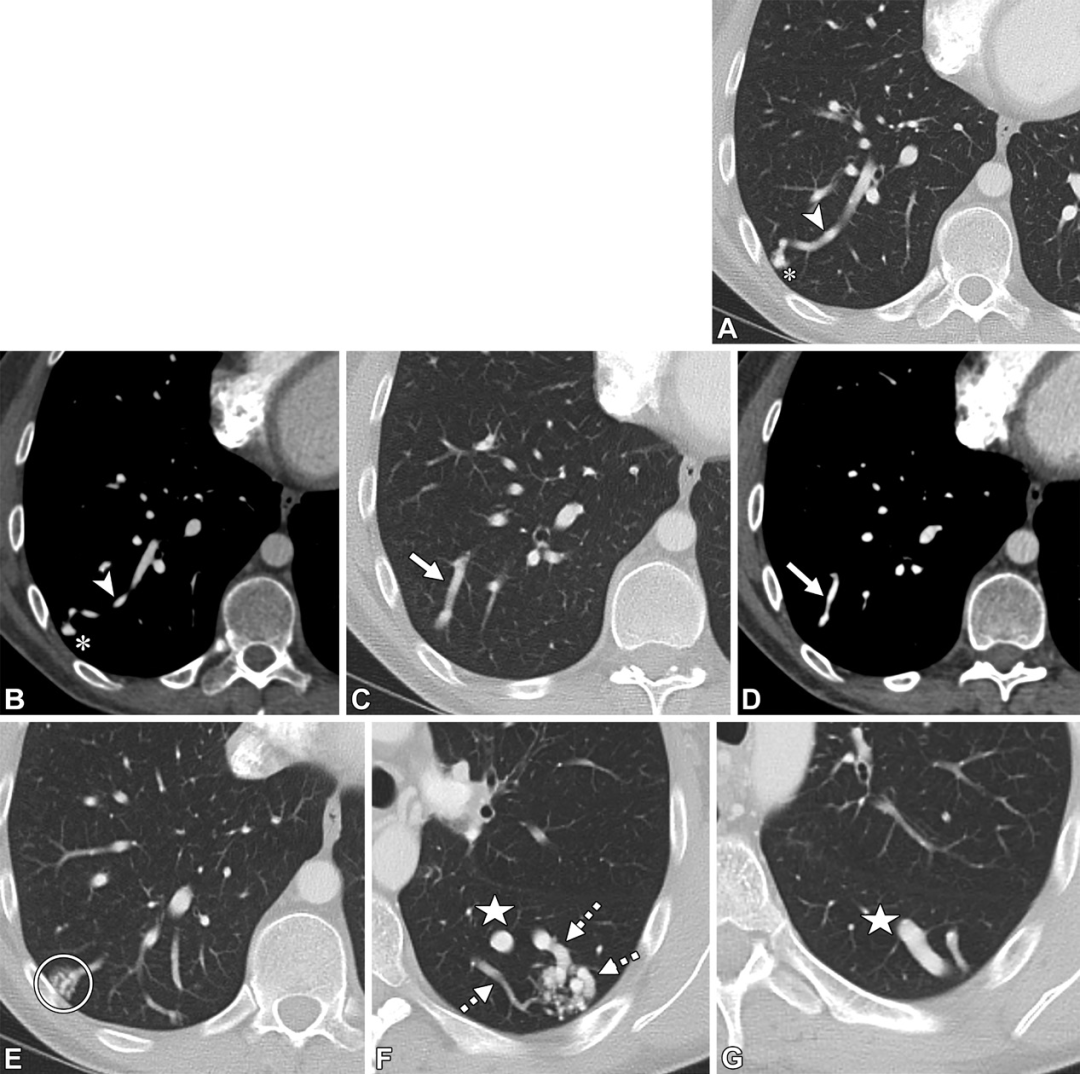 肺动静脉畸形及类似病变的CT表现-1