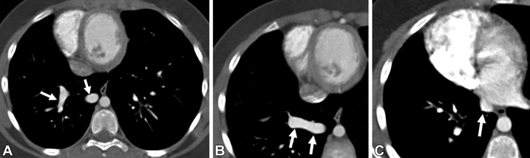 肺动静脉畸形及类似病变的CT表现-7