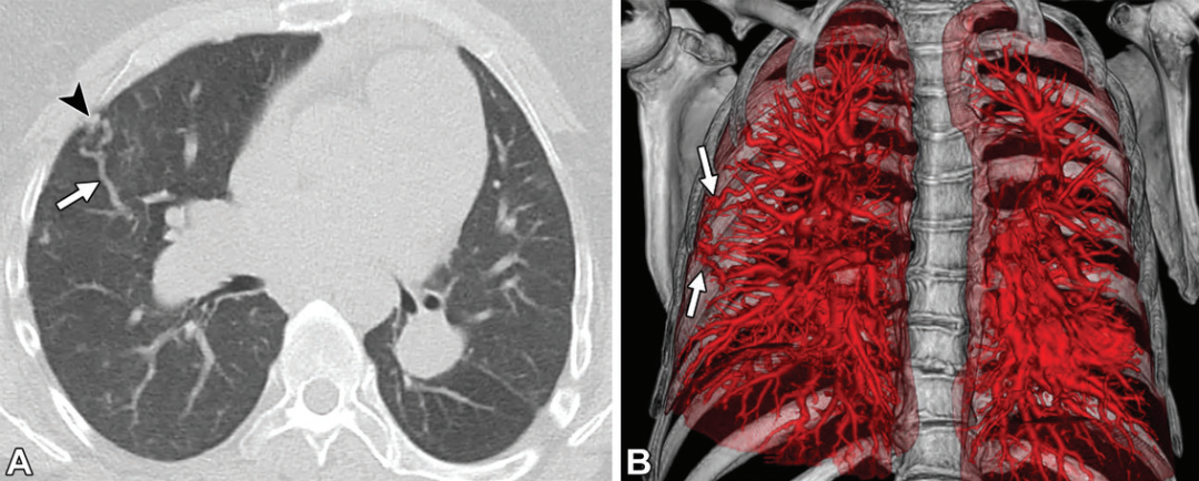 肺动静脉畸形及类似病变的CT表现-6