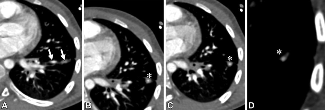 肺动静脉畸形及类似病变的CT表现-10