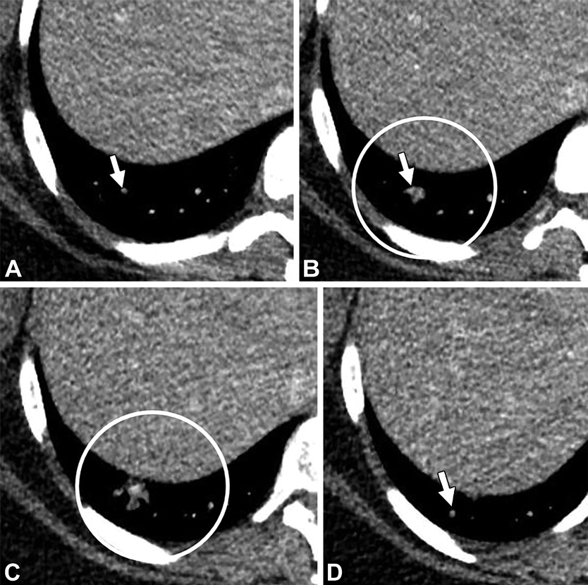 肺动静脉畸形及类似病变的CT表现-9