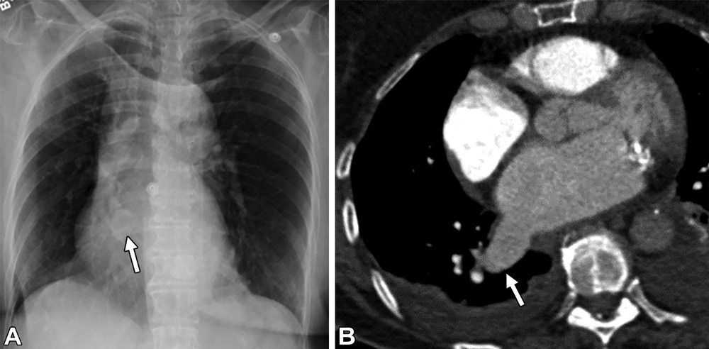 肺动静脉畸形及类似病变的CT表现-8
