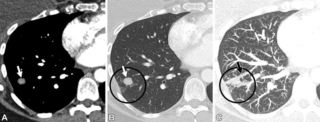 肺动静脉畸形及类似病变的CT表现-11