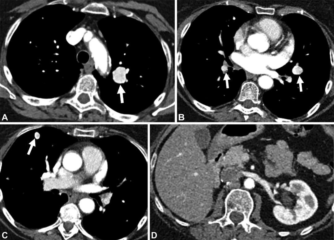 肺动静脉畸形及类似病变的CT表现-12