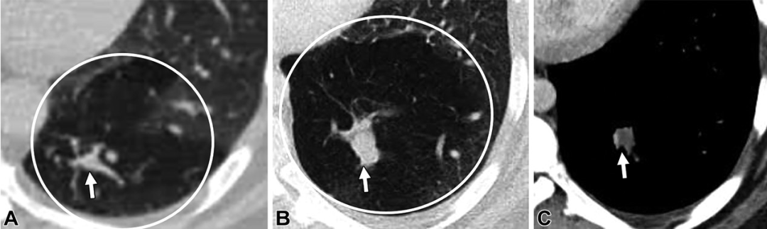 肺动静脉畸形及类似病变的CT表现-14