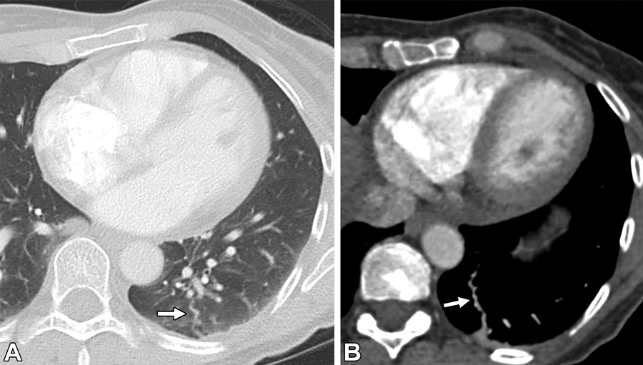 肺动静脉畸形及类似病变的CT表现-15