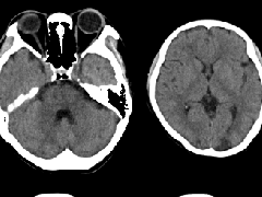 特鲁索综合征1例CT及MR影像