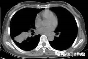 支气管树爬行征详解-3