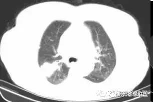 支气管树爬行征详解-4