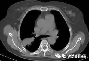 支气管树爬行征详解-5