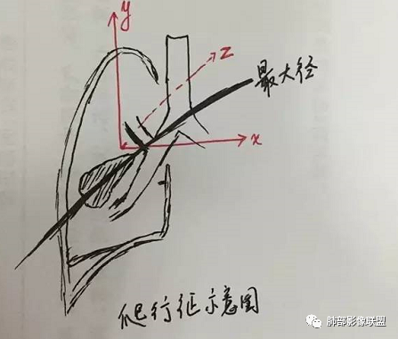 支气管树爬行征详解-1