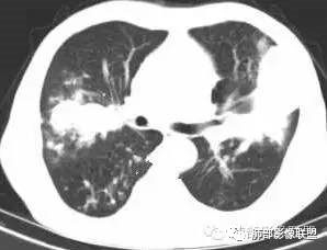 支气管树爬行征详解-6