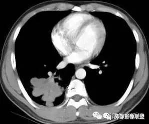 支气管树爬行征详解-9