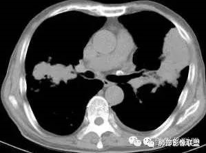 支气管树爬行征详解-7