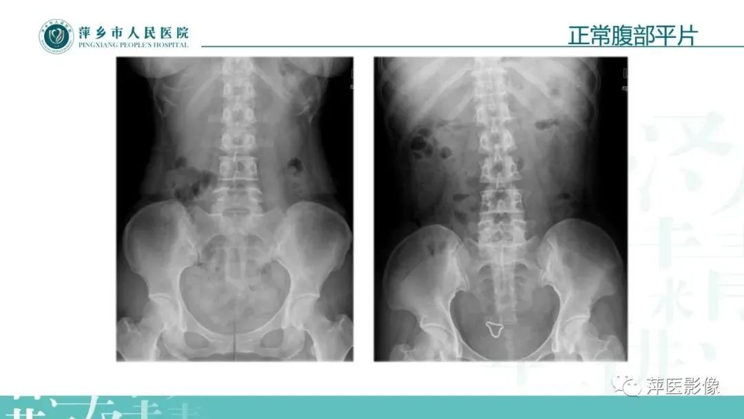 【PPT】腹部X线基础影像-14