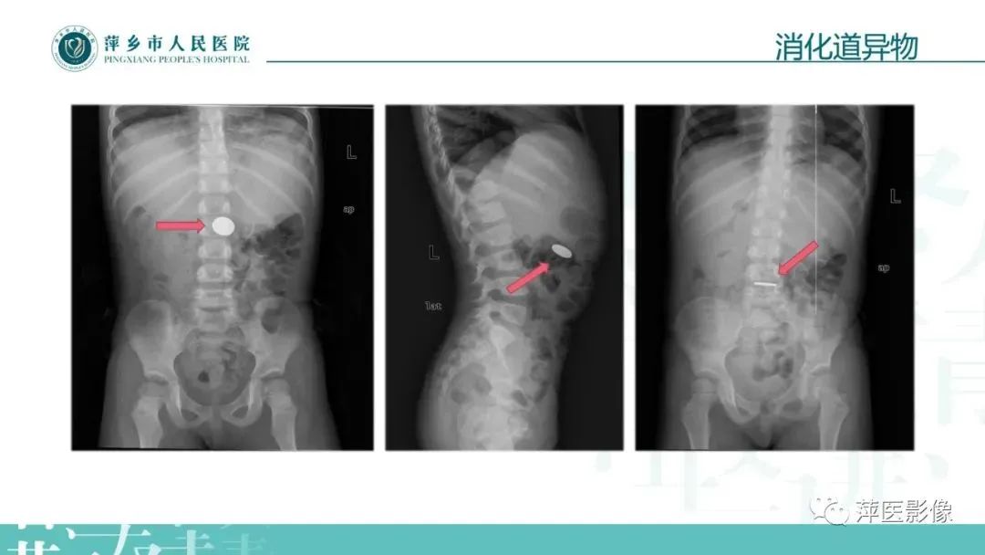 【PPT】腹部X线基础影像-15