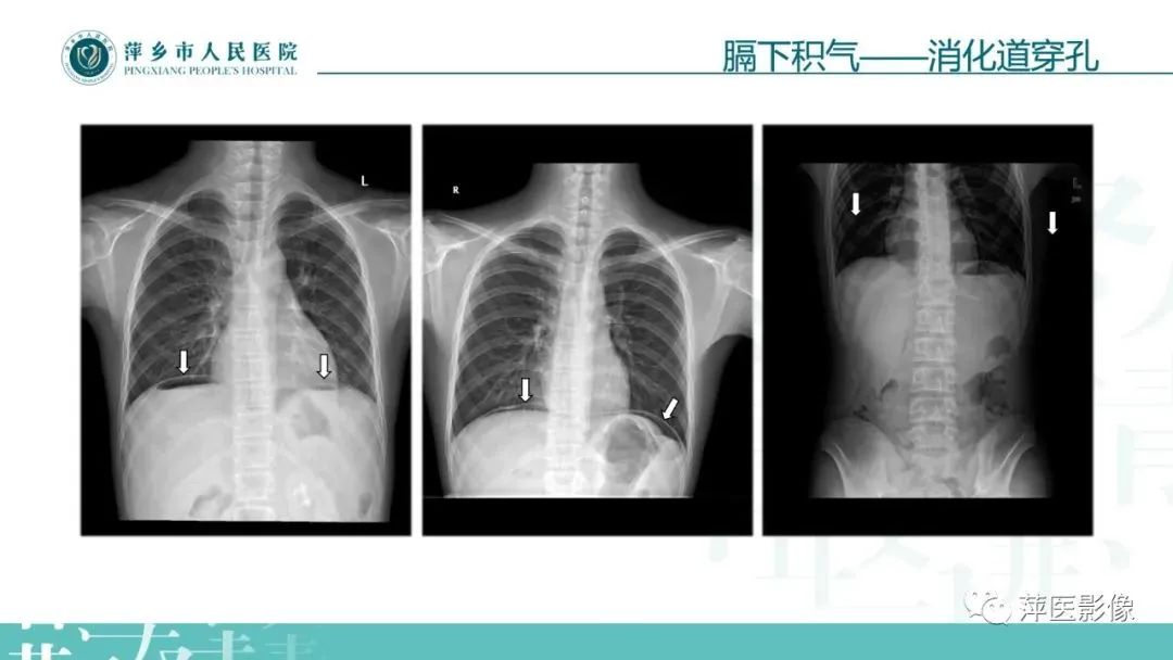 【PPT】腹部X线基础影像-17
