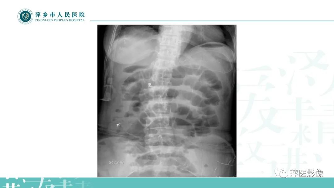 【PPT】腹部X线基础影像-19