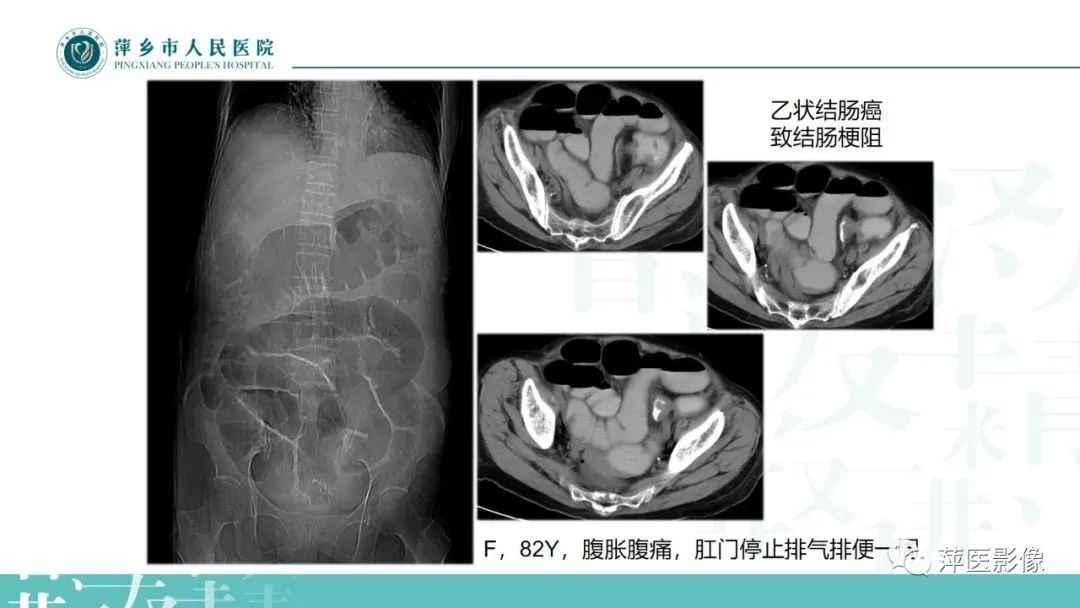 【PPT】腹部X线基础影像-21