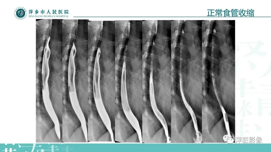 【PPT】腹部X线基础影像-27