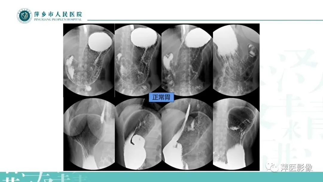 【PPT】腹部X线基础影像-30